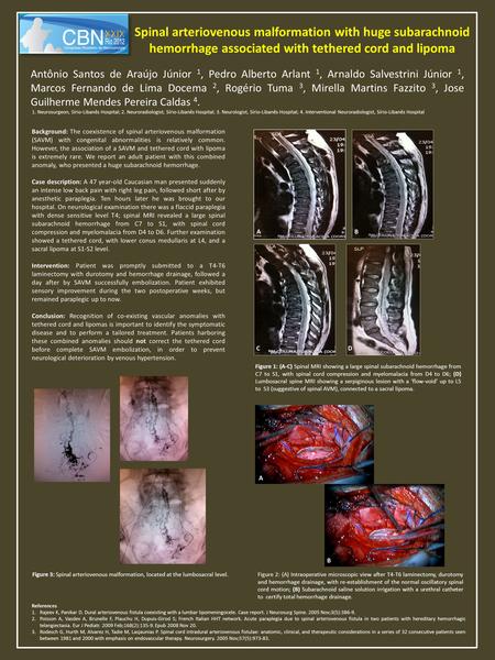 Spinal arteriovenous malformation with huge subarachnoid hemorrhage associated with tethered cord and lipoma Antônio Santos de Araújo Júnior 1, Pedro Alberto.