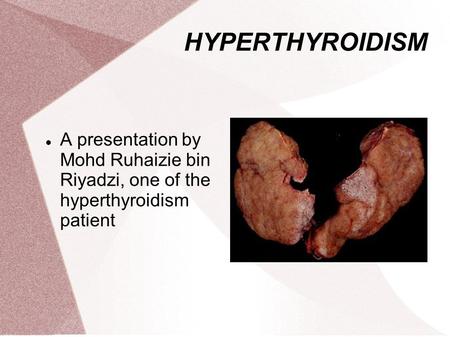 HYPERTHYROIDISM A presentation by Mohd Ruhaizie bin Riyadzi, one of the hyperthyroidism patient.
