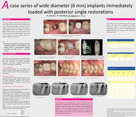 Case series of wide diameter (6 mm) implants immediately loaded with posterior single restorations A Immediate loading of implants replacing single molars.