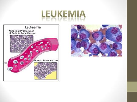 Leukemia.