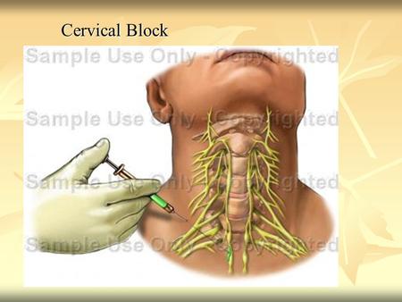 Cervical Block. Spinal anesthesia Spinal anesthesia : Subarachnoid or intrathecal anaesthetia- the drug is injected into subarachnoid space so it.