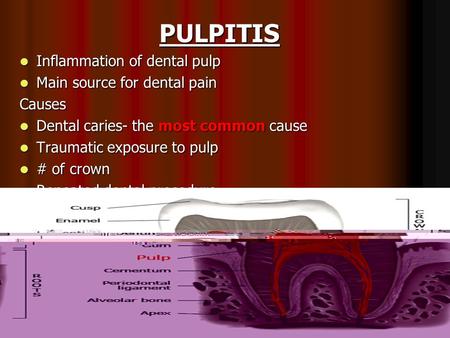 PULPITIS Inflammation of dental pulp Main source for dental pain