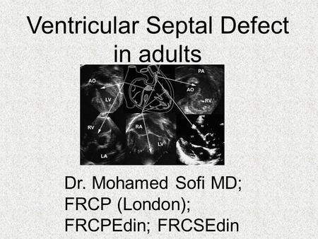 Ventricular Septal Defect in adults