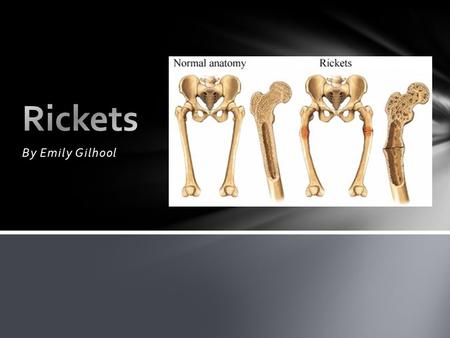 By Emily Gilhool. Softening and weakening of the bones Different Types: Hypophosphatemic Rickets Kidney Rickets Nutritional Rickets Rickets.