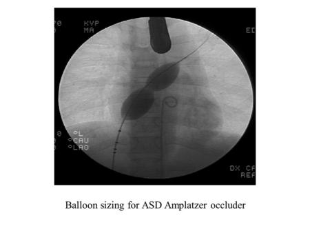 Balloon sizing for ASD Amplatzer occluder. ASD s/p Amplatzer occluder (arrow)