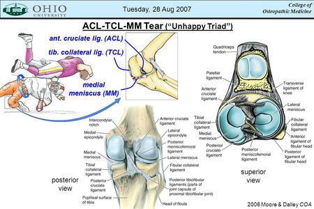 College of Osteopathic Medicine Tuesday, 28 Aug 2007 ACL-TCL-MM Tear (“Unhappy Triad”) 2006 Moore & Dalley COA superior view posterior view ant. cruciate.