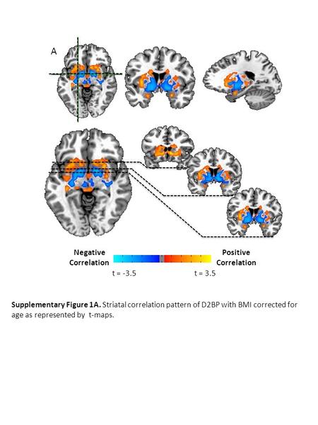 Supplementary Figure 1A. Striatal correlation pattern of D2BP with BMI corrected for age as represented by t-maps. A Negative Correlation Positive Correlation.