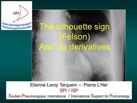 The silhouette sign (Felson) And its derivatives Etienne Leroy Terquem – Pierre L’Her SPI / ISP S outien P neumologique International / I nternational.