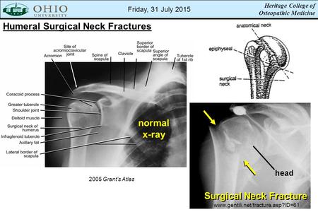 Humeral Surgical Neck Fractures