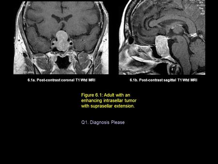 6.1b. Post-contrast sagittal T1 Wtd MRI