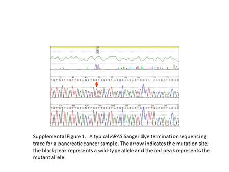 Supplemental Figure 1. A typical KRAS Sanger dye termination sequencing trace for a pancreatic cancer sample. The arrow indicates the mutation site; the.