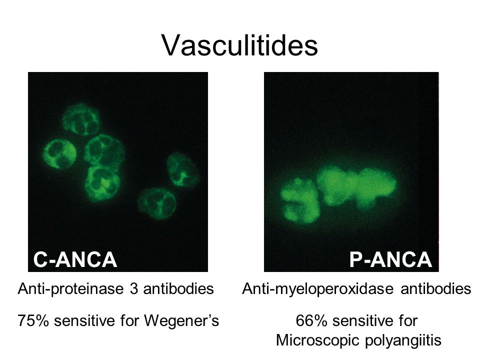 Vasculitides+C ANCA+P ANCA+Anti proteinase+3+antibodies