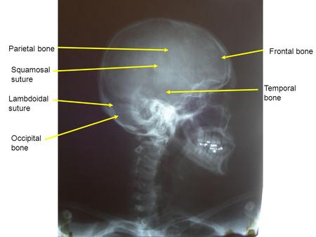 Parietal bone Frontal bone Occipital bone Lambdoidal suture Squamosal suture Temporal bone.