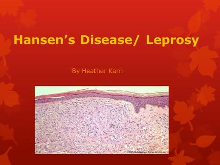 Hansen’s Disease/ Leprosy By Heather Karn. What is it?  an infectious disease that has been known since biblical times. It is characterized by disfiguring.