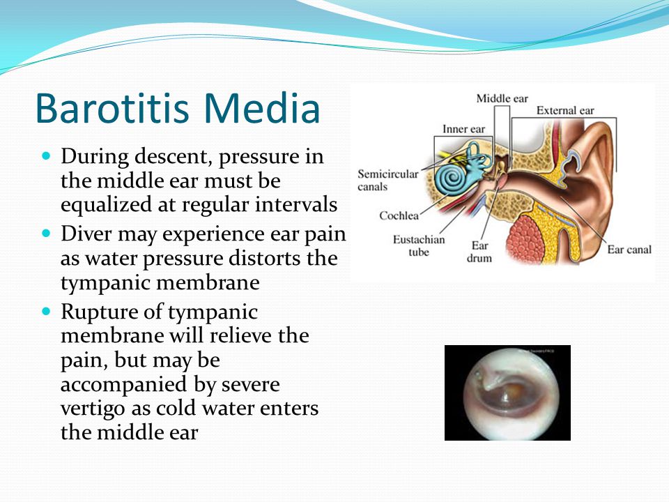 Image result for Barotitis media