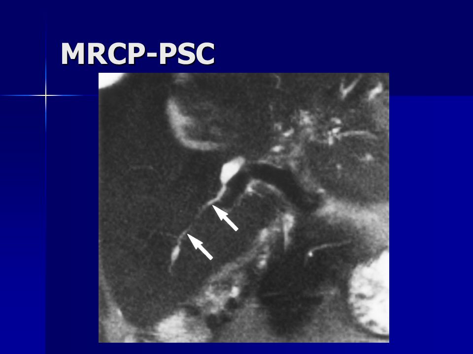 Fatty Liver Disease Diagnoses Liver Biopsy Hunstville AL
