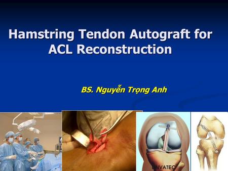Hamstring Tendon Autograft for ACL Reconstruction