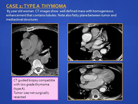 CASE 1: type A thymoma 83 year old woman. CT images show well defined mass with homogeneous enhancement that contains lobules. Note also fatty plane.