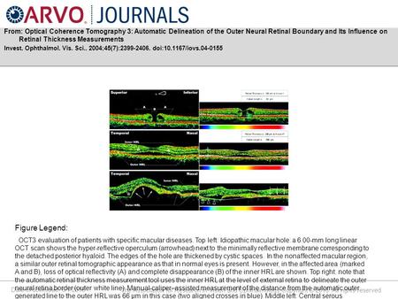 Date of download: 6/1/2016 The Association for Research in Vision and Ophthalmology Copyright © 2016. All rights reserved. From: Optical Coherence Tomography.