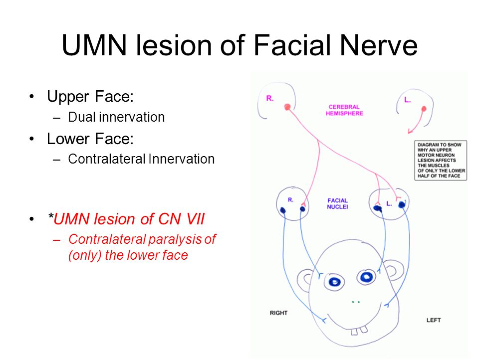 Facial Nerve Lesion 37