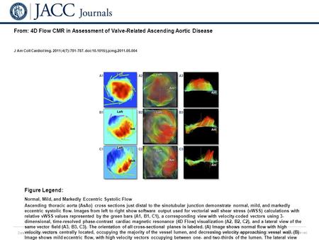 Date of download: 6/25/2016 Copyright © The American College of Cardiology. All rights reserved. From: 4D Flow CMR in Assessment of Valve-Related Ascending.