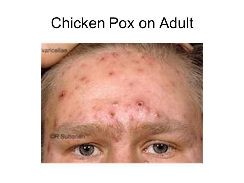Pox Porn Photo 116