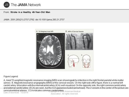 Date of download: 7/2/2016 Copyright © 2016 American Medical Association. All rights reserved. From: Stroke in a Healthy 46-Year-Old Man JAMA. 2001;285(21):2757-2762.