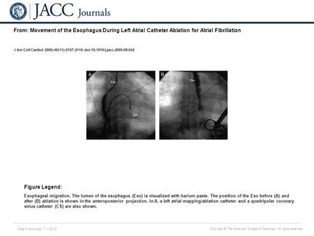 Date of download: 7/11/2016 Copyright © The American College of Cardiology. All rights reserved. From: Movement of the Esophagus During Left Atrial Catheter.