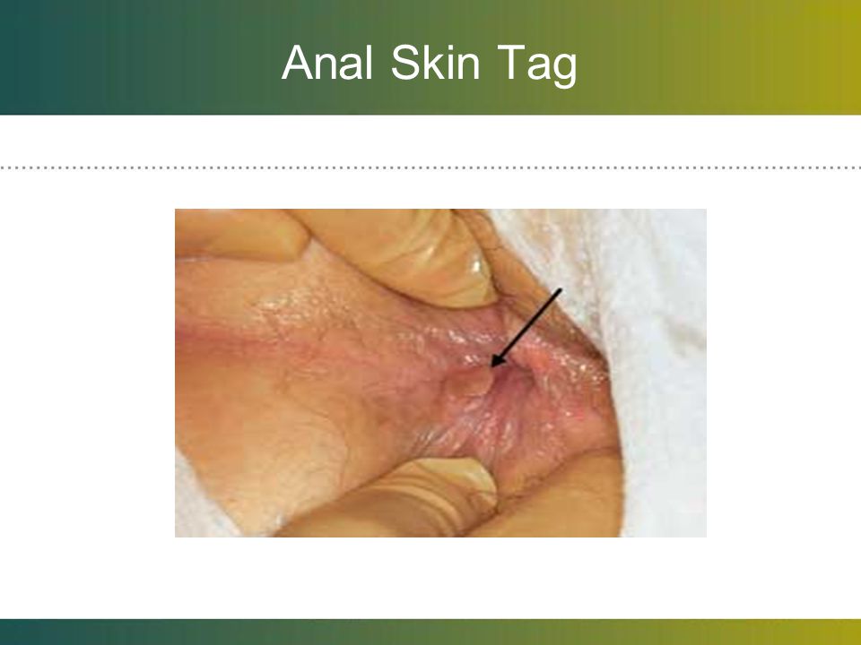 Anal Skin Tag Picture 36