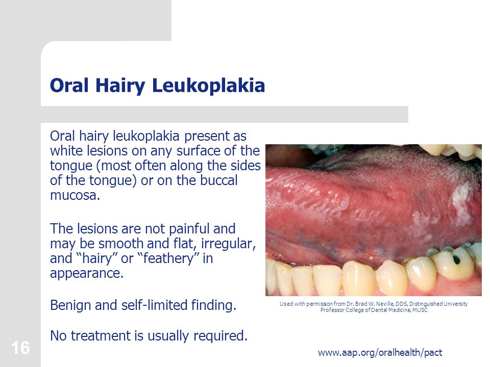 Pictures Of Oral Hairy Leukoplakia 54