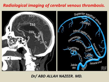 Radiological imaging of cerebral venous thrombosis.