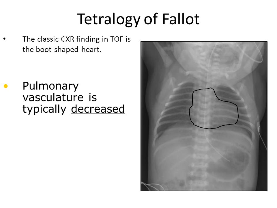congenital heart defects ppt video online download boot shaped heart