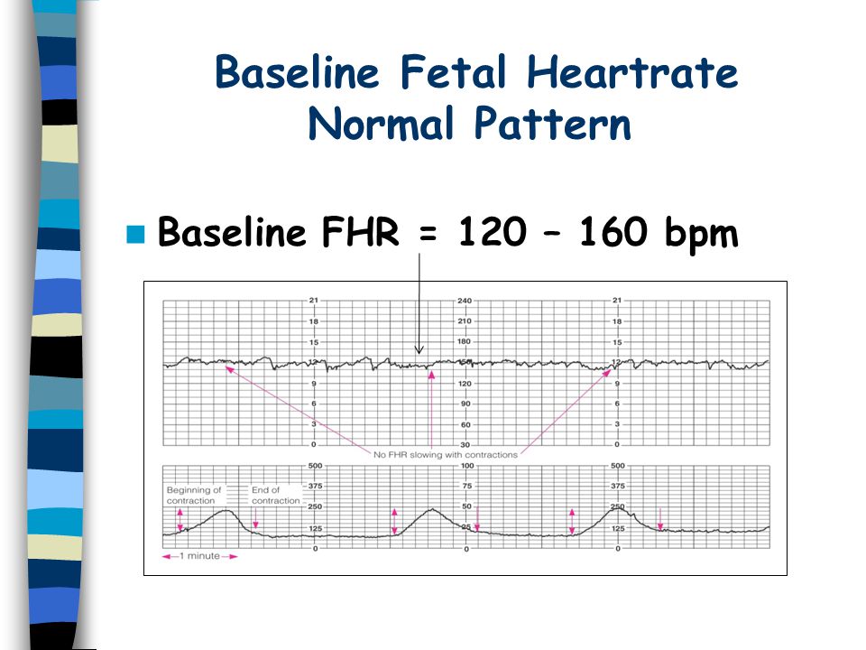 Baseline+Fetal+Heartrate+Normal+Pattern