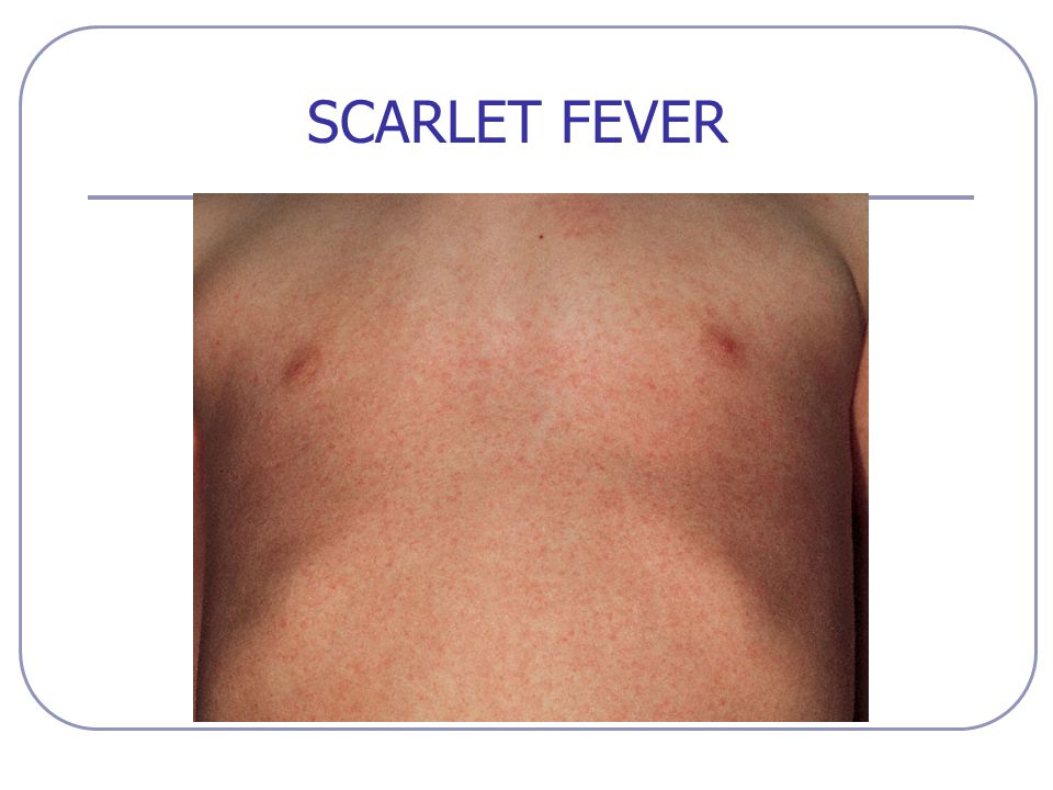 Képtalálat a következőre: „scarlet fever skin”