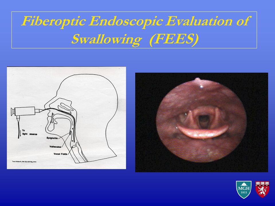 Fiberoptic Endoscopic Evaluation Of Swallow 74