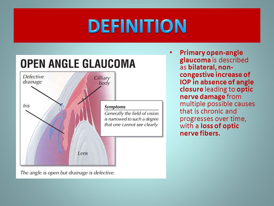 Optic nerve and open angle glaucoma
