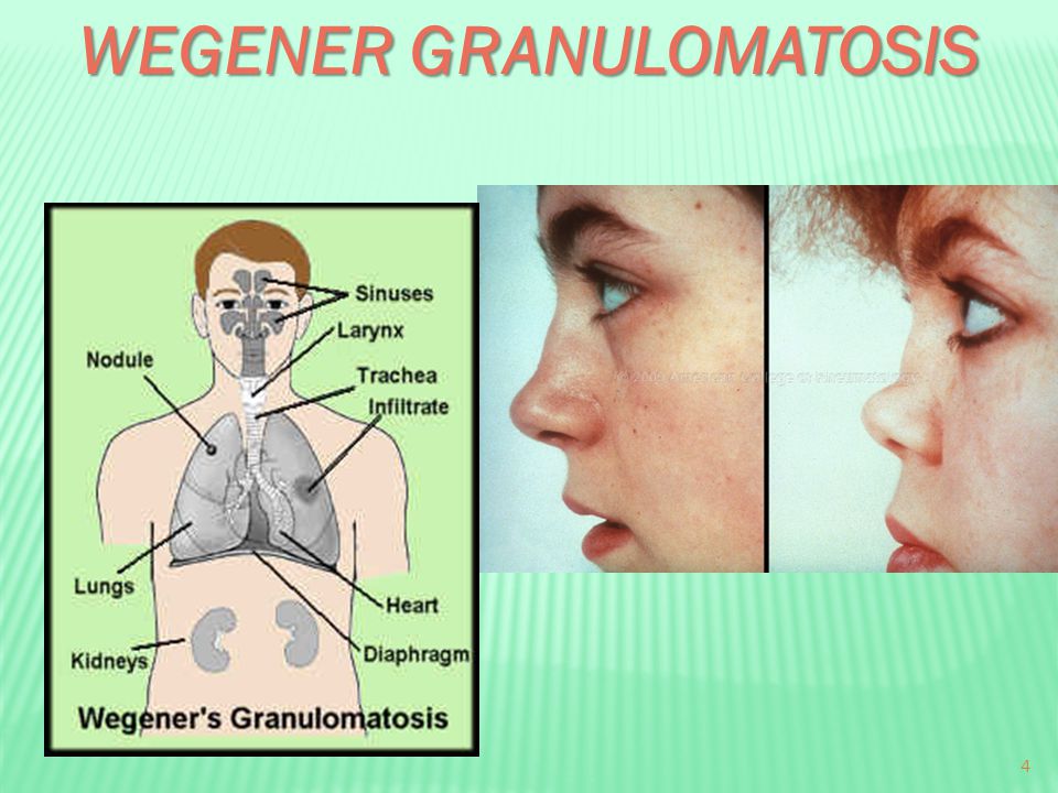 Image result for Wegener's disease