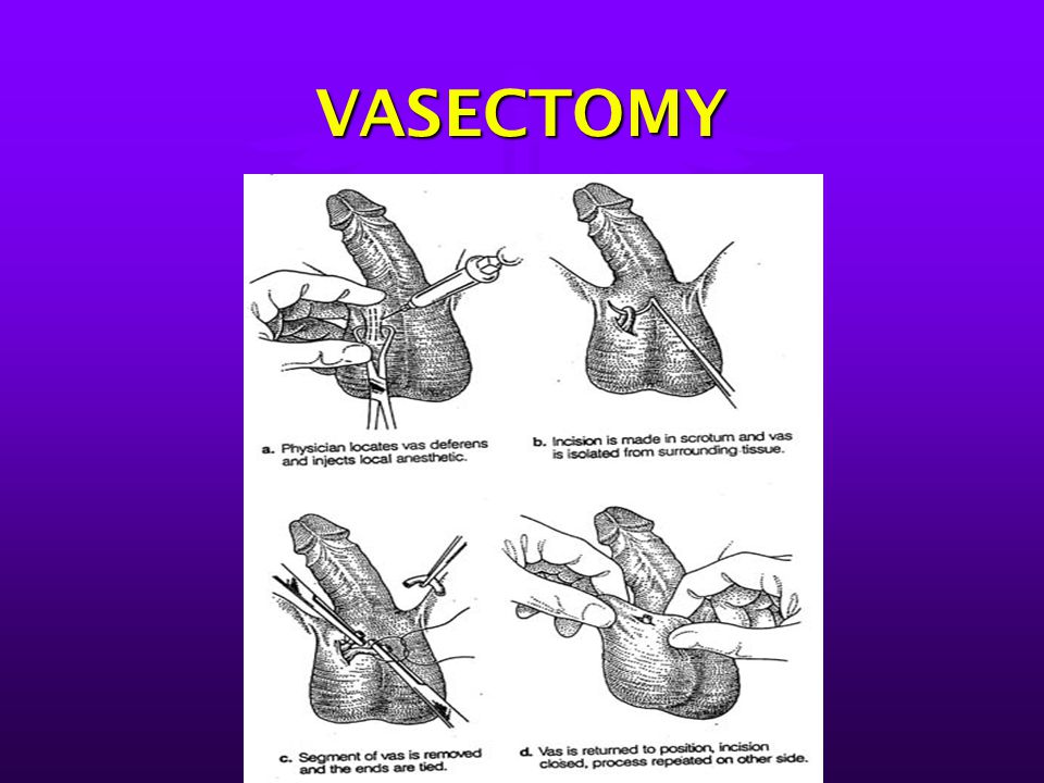 Vasectomy Orgasm Not The Same Pics And Galleries