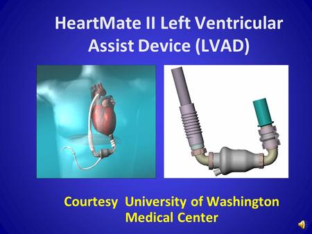 BACKGROUND Ventricular assist devices (VADs) are a proven therapy as bridge-to-cardiac transplantation in Class IIIB and Class IV heart failure patients.