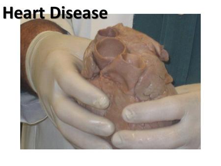 Heart Disease.