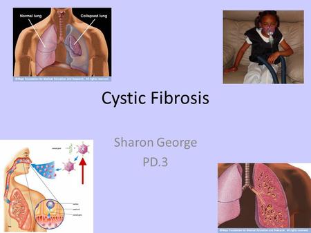Cystic Fibrosis Sharon George PD.3. Cystic Fibrosis is inherited when the child inherits two mutated CFTR genes, one from each parent. The presence of.