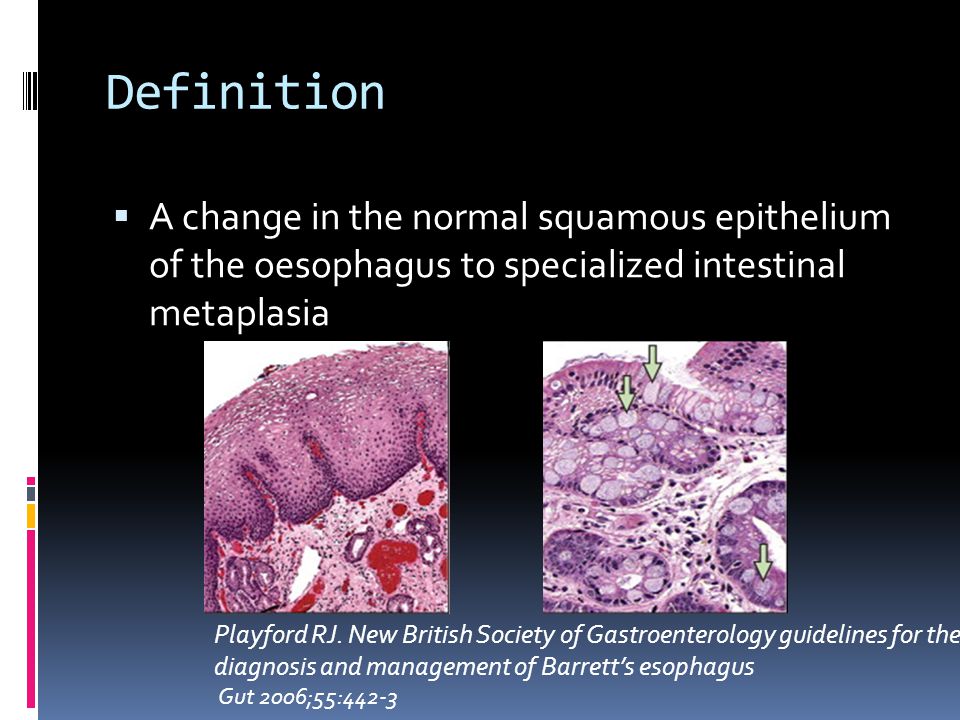 of the oesophagus to specialized intestinal  metaplasianormal