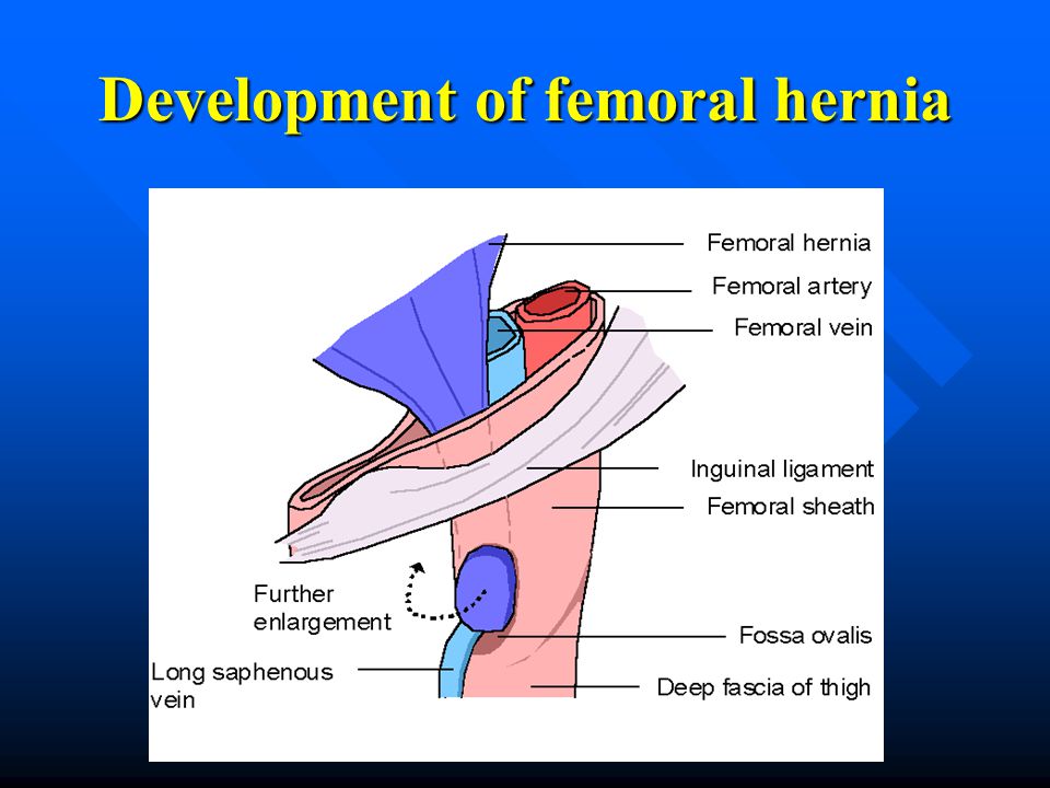 Femoral Hernia Cause Weight Loss