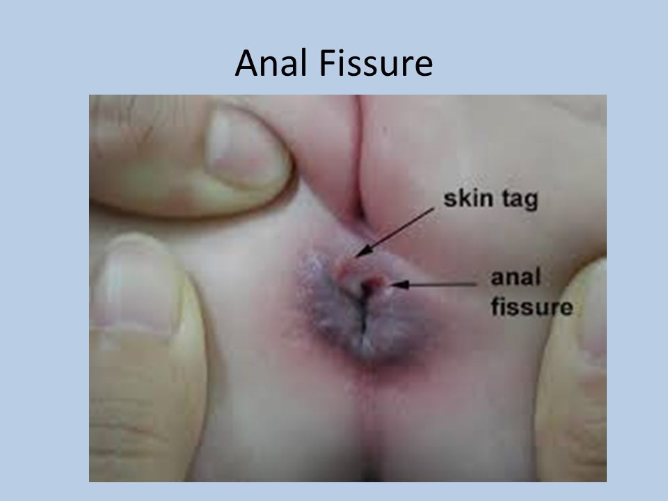 Anal Fisures 6