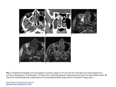 Fig. 2. Computed tomography (CT) and magnetic resonance images of 34-year-old man with right nasal tumor diagnosed as cavernous hemangioma. A. Early-phase.