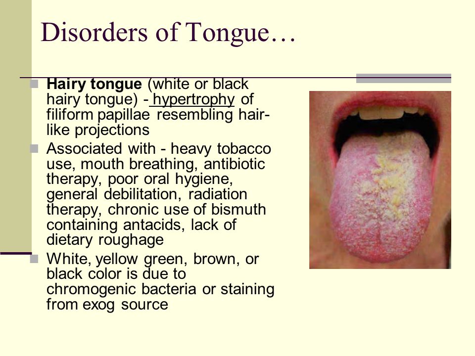 Hairy Coated Tongue 35