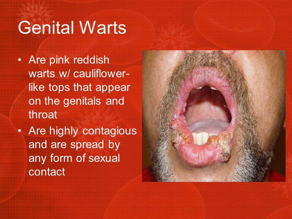 Genital+Warts+Are+pink+reddish+warts+w%2F+cauliflower-like+tops+that+appear+on+the+genitals+and+throat..jpg