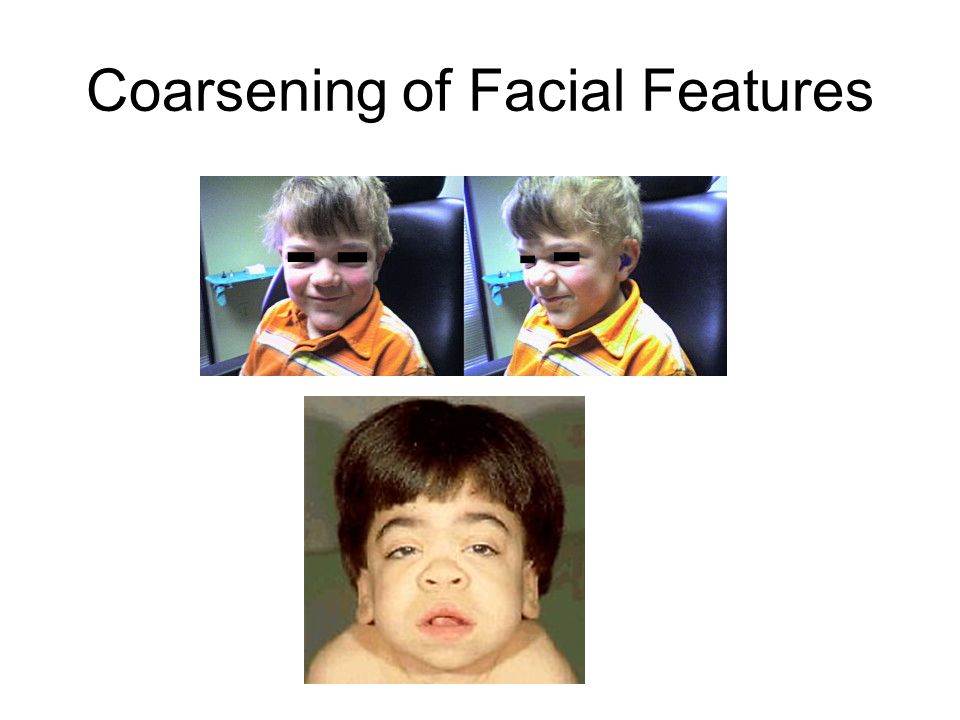 Coarsening Of Facial 28