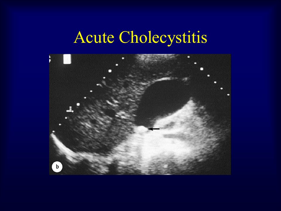 Acute cholecystitis - slidesharenet