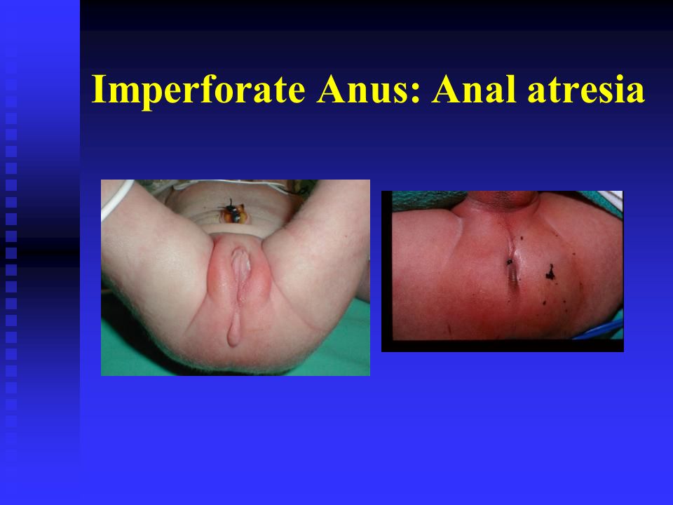 Congenital Anal Atresia 74